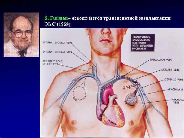S. Furman– освоил метод трансвенозной имплантации ЭКС (1958) 
