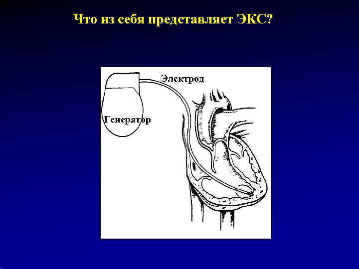 Что из себя представляет ЭКС?     Электрод  Генератор 