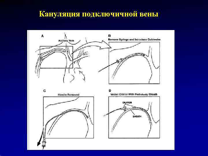 Кануляция подключичной вены 