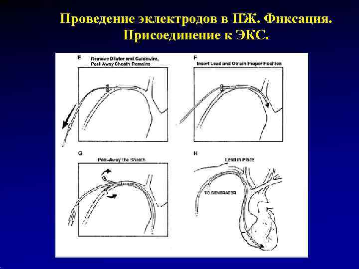 Проведение эклектродов в ПЖ. Фиксация.   Присоединение к ЭКС. 