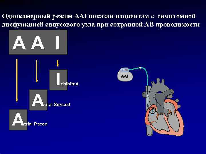 Однокамерный режим AAI показан пациентам с симптомной дисфункцией синусового узла при сохранной АВ проводимости