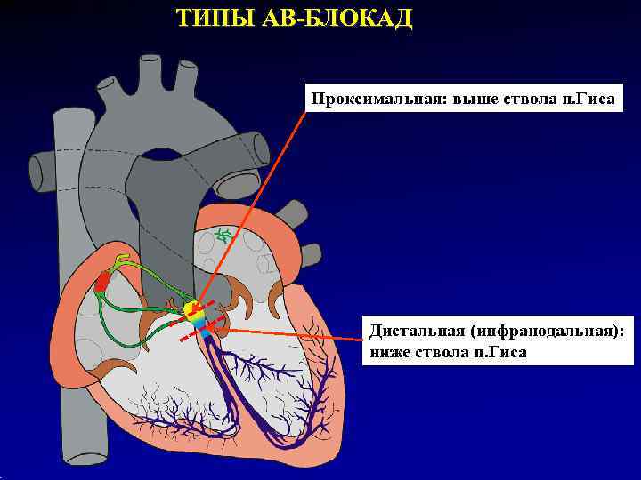 ТИПЫ АВ-БЛОКАД  Проксимальная: выше ствола п. Гиса    Дистальная (инфранодальная): 