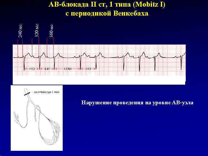    АВ-блокада II ст, 1 типа (Mobitz I)    с