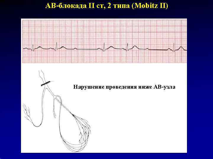 АВ-блокада II ст, 2 типа (Mobitz II)   Нарушение проведения ниже АВ-узла 