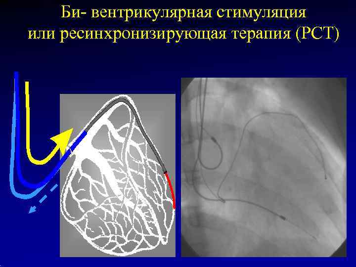   Би- вентрикулярная стимуляция или ресинхронизирующая терапия (РСТ) 