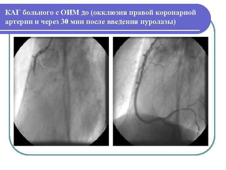 КАГ больного с ОИМ до (окклюзия правой коронарной артерии и через 30 мин после