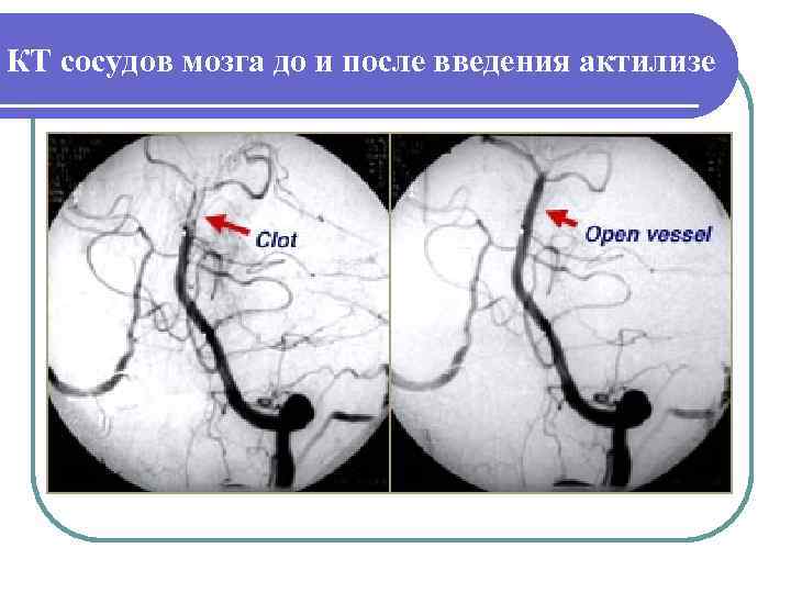 КТ сосудов мозга до и после введения актилизе 