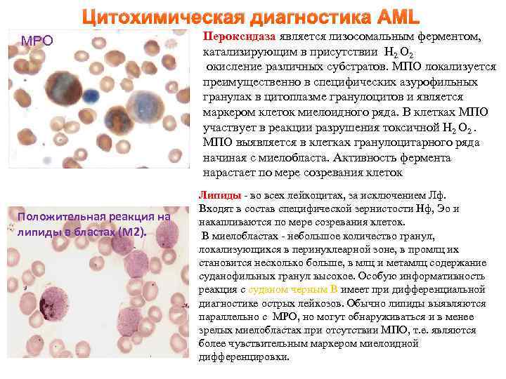    Цитохимическая диагностика AML MPO    Пероксидаза является лизосомальным ферментом,