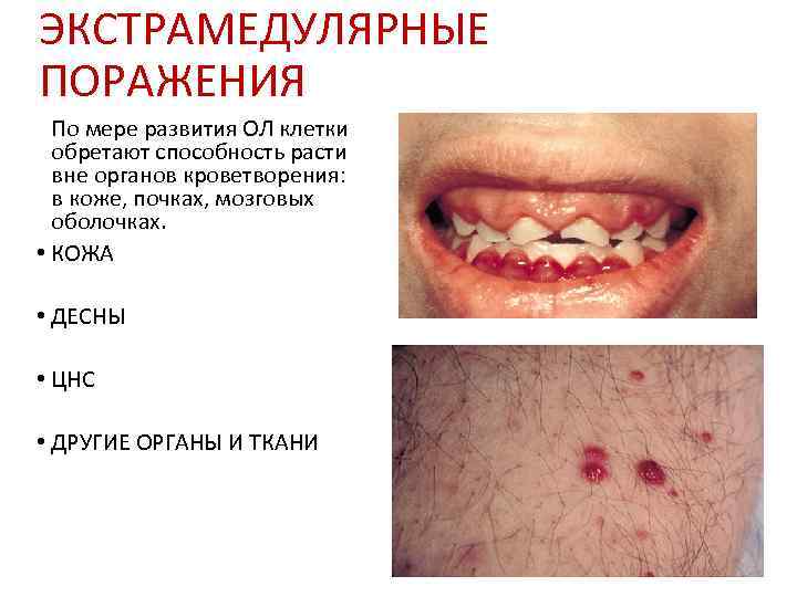 ЭКСТРАМЕДУЛЯРНЫЕ ПОРАЖЕНИЯ  По мере развития ОЛ клетки  обретают способность расти  вне