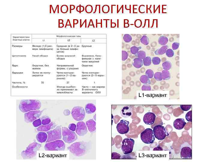   МОРФОЛОГИЧЕСКИЕ ВАРИАНТЫ В-ОЛЛ    L 1 -вариант L 2 -вариант