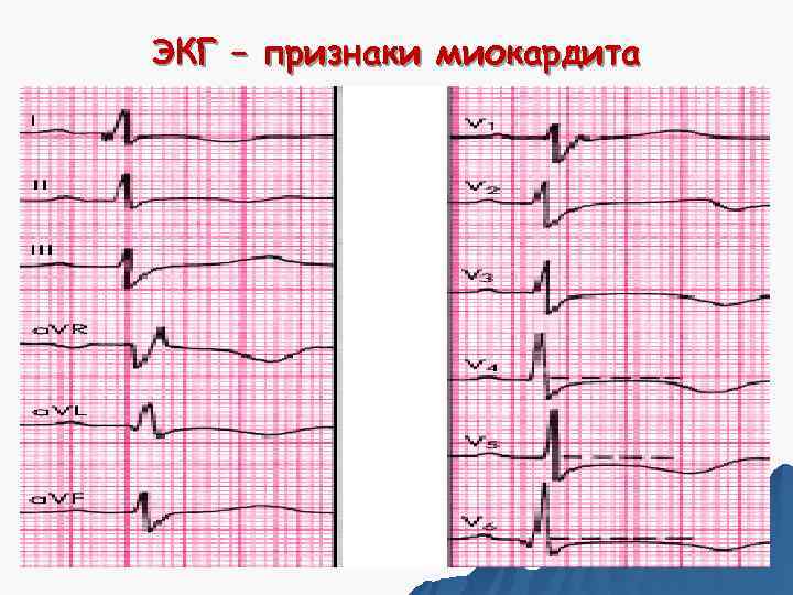 ЭКГ – признаки миокардита 