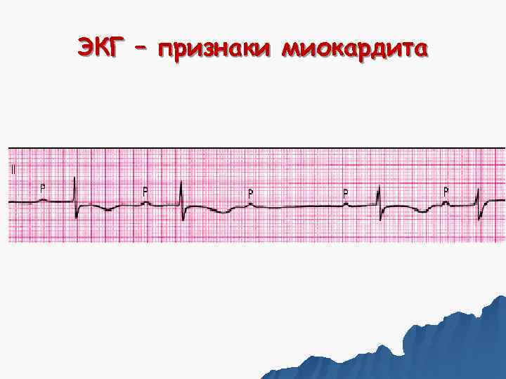 ЭКГ – признаки миокардита 