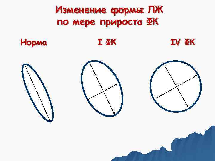   Изменение формы ЛЖ   по мере прироста ФК Норма  