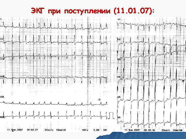 ЭКГ при поступлении (11. 07): 
