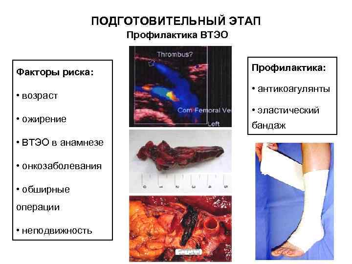    ПОДГОТОВИТЕЛЬНЫЙ ЭТАП     Профилактика ВТЭО  Факторы риска: