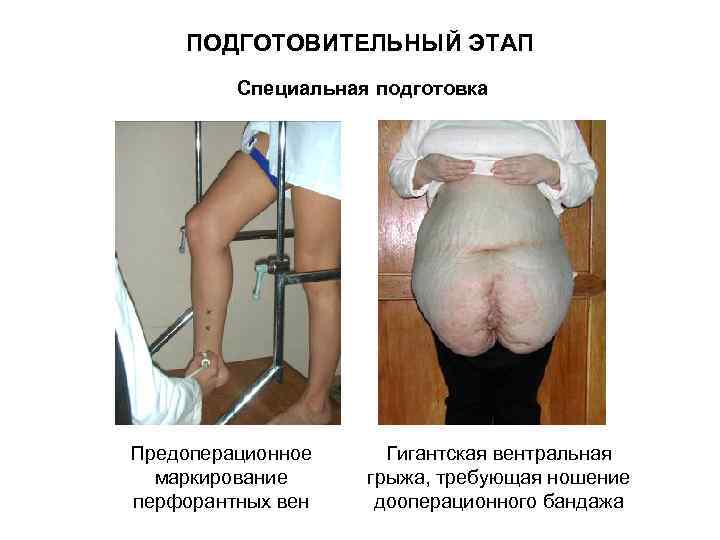   ПОДГОТОВИТЕЛЬНЫЙ ЭТАП   Специальная подготовка Предоперационное Гигантская вентральная  маркирование грыжа,