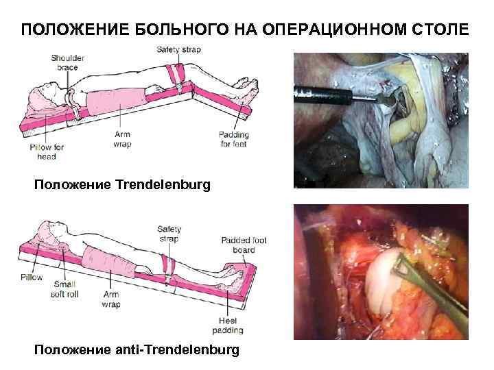 Выберите нужное положение больного геморроем на операционном столе