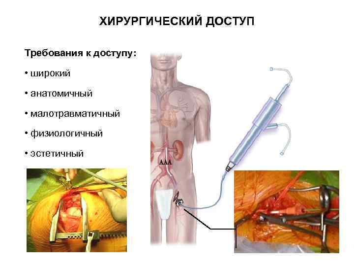    ХИРУРГИЧЕСКИЙ ДОСТУП Требования к доступу:  • широкий • анатомичный