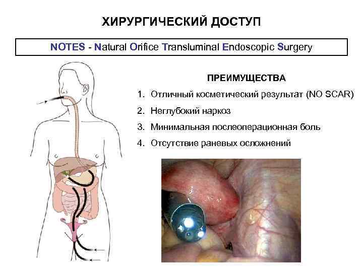    ХИРУРГИЧЕСКИЙ ДОСТУП NOTES - Natural Orifice Transluminal Endoscopic Surgery  