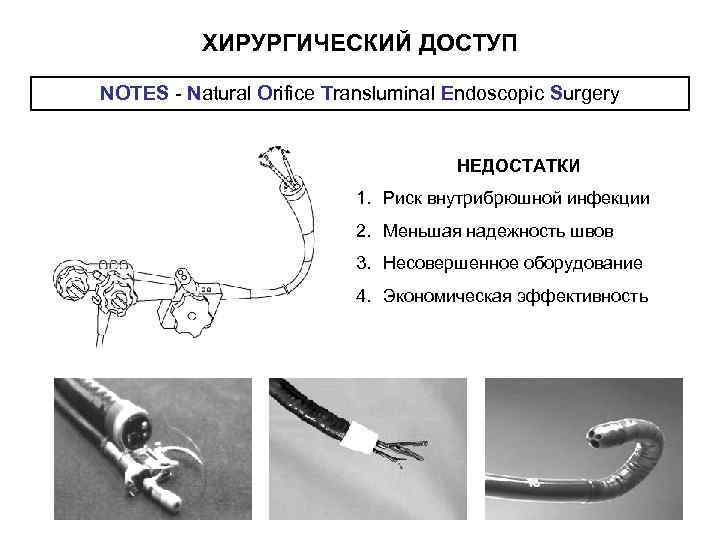    ХИРУРГИЧЕСКИЙ ДОСТУП NOTES - Natural Orifice Transluminal Endoscopic Surgery  
