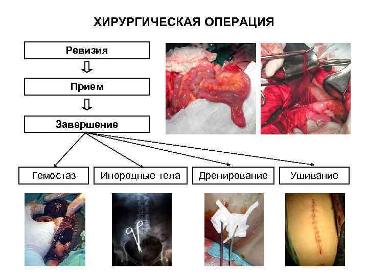   ХИРУРГИЧЕСКАЯ ОПЕРАЦИЯ  Ревизия   Прием  Завершение Гемостаз  Инородные