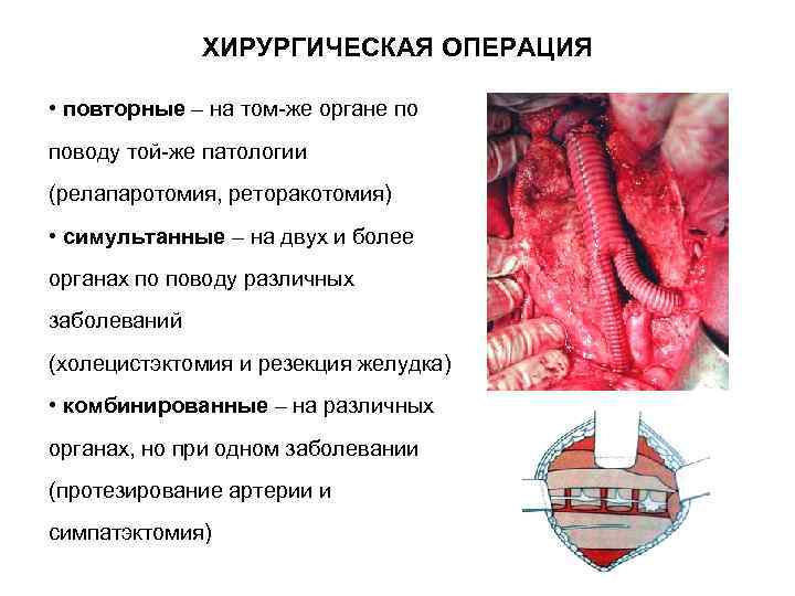    ХИРУРГИЧЕСКАЯ ОПЕРАЦИЯ  • повторные – на том-же органе по поводу