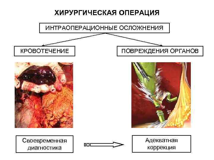    ХИРУРГИЧЕСКАЯ ОПЕРАЦИЯ  ИНТРАОПЕРАЦИОННЫЕ ОСЛОЖНЕНИЯ  КРОВОТЕЧЕНИЕ  ПОВРЕЖДЕНИЯ ОРГАНОВ Своевременная