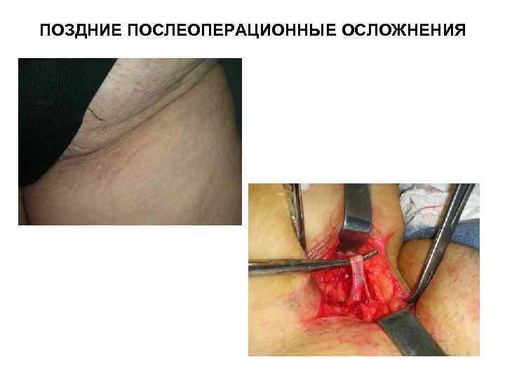 ПОЗДНИЕ ПОСЛЕОПЕРАЦИОННЫЕ ОСЛОЖНЕНИЯ 