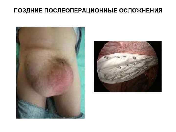 ПОЗДНИЕ ПОСЛЕОПЕРАЦИОННЫЕ ОСЛОЖНЕНИЯ 