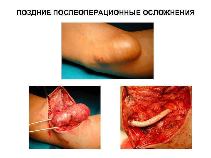 ПОЗДНИЕ ПОСЛЕОПЕРАЦИОННЫЕ ОСЛОЖНЕНИЯ 