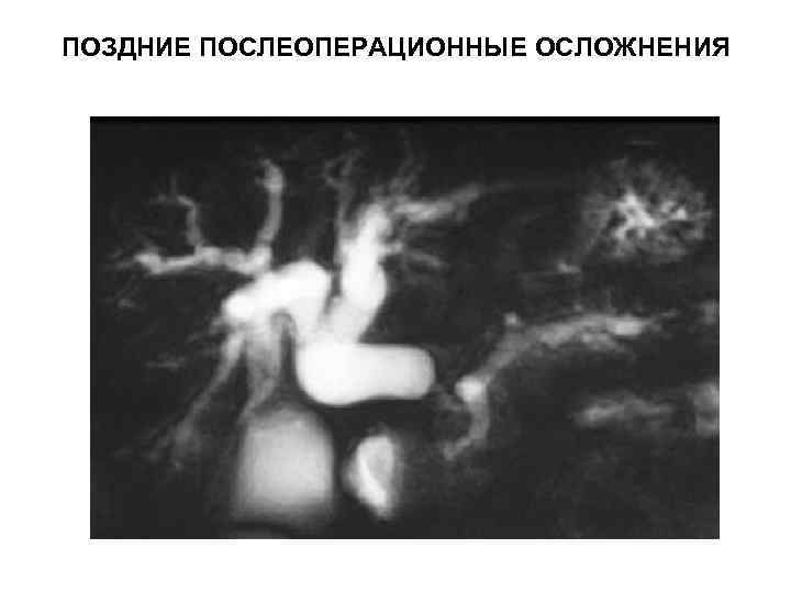 ПОЗДНИЕ ПОСЛЕОПЕРАЦИОННЫЕ ОСЛОЖНЕНИЯ 