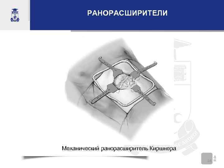   РАНОРАСШИРИТЕЛИ Механический ранорасширитель Киршнера       18 