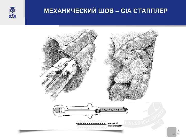 МЕХАНИЧЕСКИЙ ШОВ – GIA СТАППЛЕР    30 