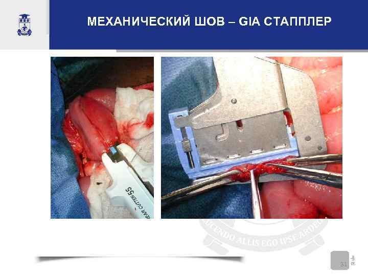 МЕХАНИЧЕСКИЙ ШОВ – GIA СТАППЛЕР    31 