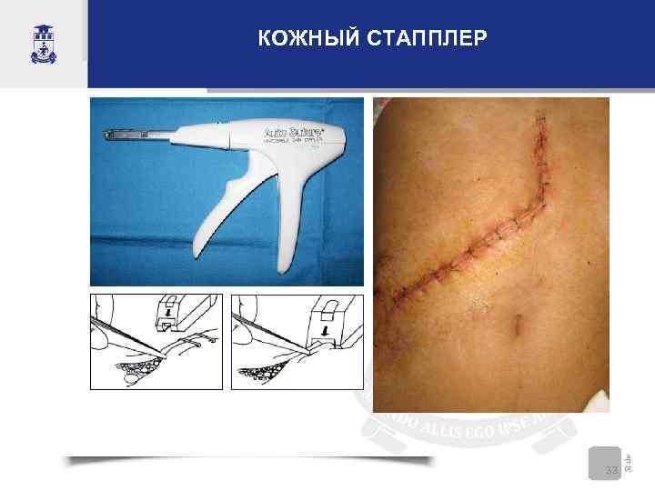 КОЖНЫЙ СТАППЛЕР    33 