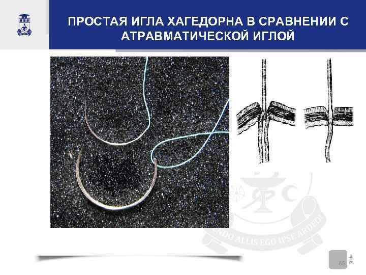 ПРОСТАЯ ИГЛА ХАГЕДОРНА В СРАВНЕНИИ С  АТРАВМАТИЧЕСКОЙ ИГЛОЙ    65 