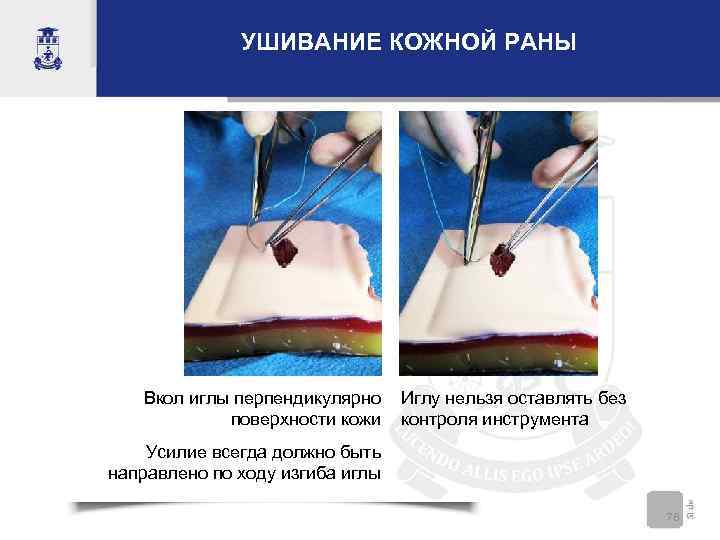    УШИВАНИЕ КОЖНОЙ РАНЫ  Вкол иглы перпендикулярно Иглу нельзя оставлять без