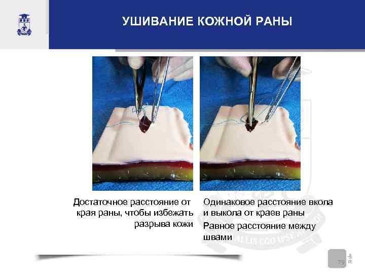   УШИВАНИЕ КОЖНОЙ РАНЫ Достаточное расстояние от Одинаковое расстояние вкола  края раны,