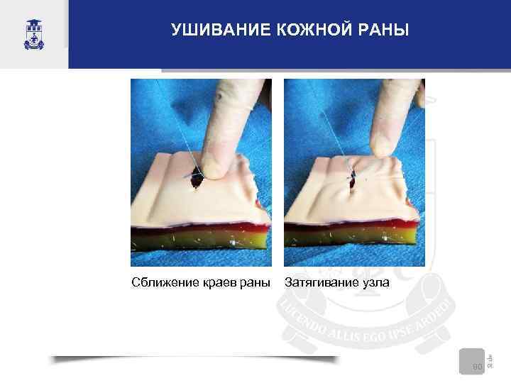  УШИВАНИЕ КОЖНОЙ РАНЫ Сближение краев раны  Затягивание узла    80