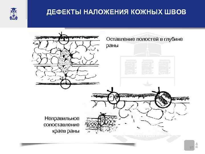  ДЕФЕКТЫ НАЛОЖЕНИЯ КОЖНЫХ ШВОВ    Оставление полостей в глубине  