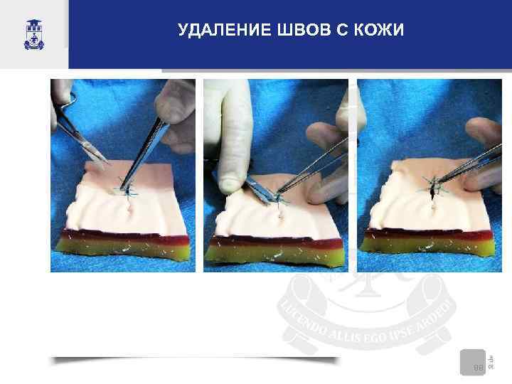 УДАЛЕНИЕ ШВОВ С КОЖИ      88 