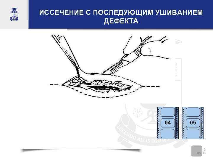 ИССЕЧЕНИЕ С ПОСЛЕДУЮЩИМ УШИВАНИЕМ    ДЕФЕКТА     04 