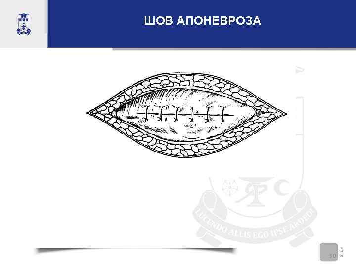 ШОВ АПОНЕВРОЗА     90 