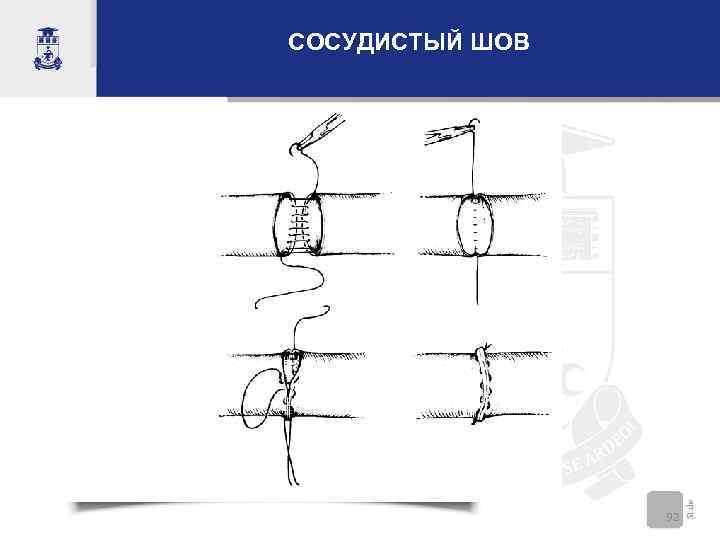 СОСУДИСТЫЙ ШОВ     92 