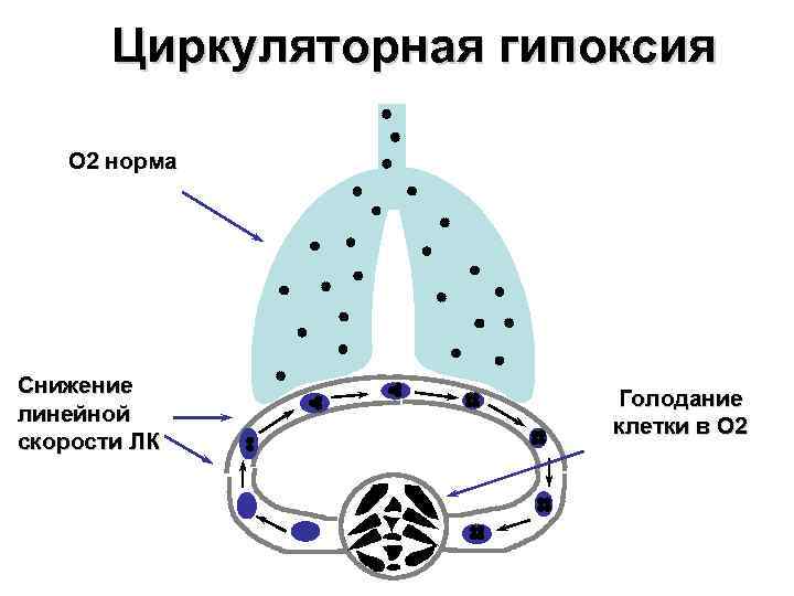   Циркуляторная гипоксия O 2 норма Снижение      Голодание
