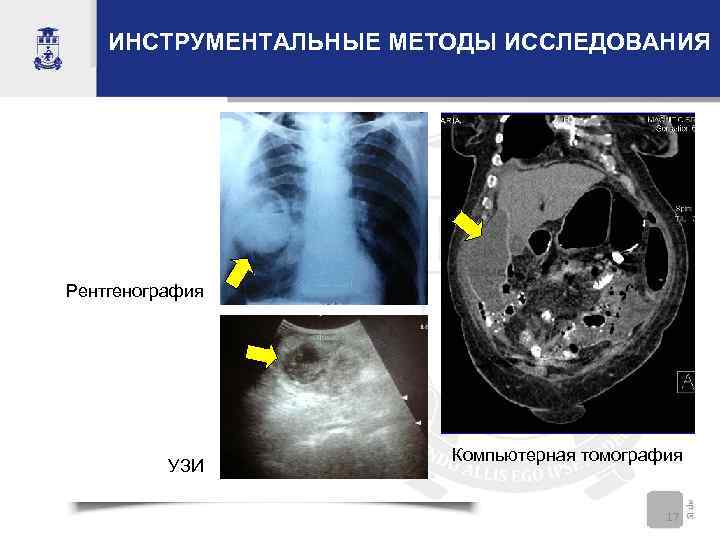   ИНСТРУМЕНТАЛЬНЫЕ МЕТОДЫ ИССЛЕДОВАНИЯ Рентгенография     Компьютерная томография  УЗИ