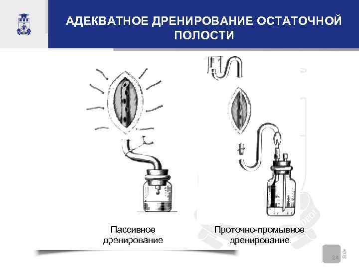 Пассивное дренирование фото