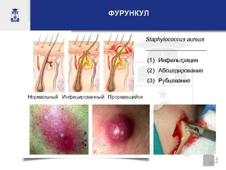      ФУРУНКУЛ    Staphylococcus aureus   