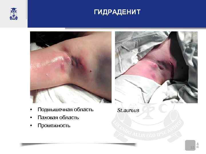     ГИДРАДЕНИТ •  Подмышечная область  St. aureus •