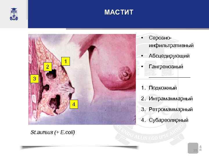     МАСТИТ      •  Серозно- 